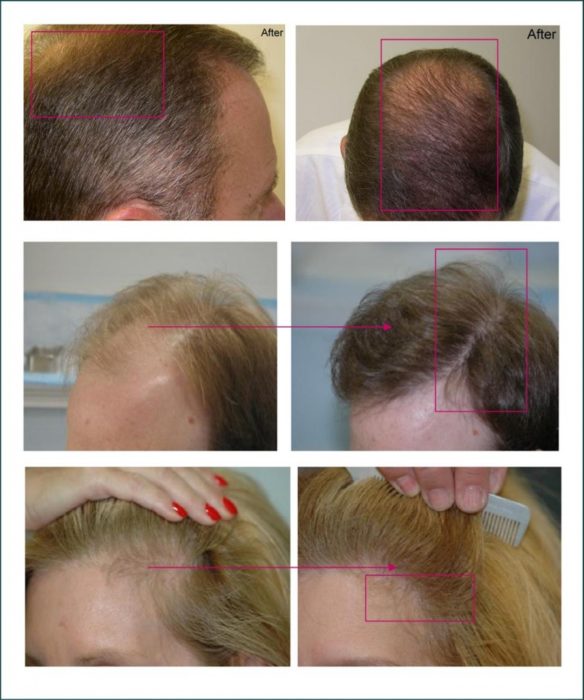 Волосы после пересадки (трансплантации); что делать дальше?